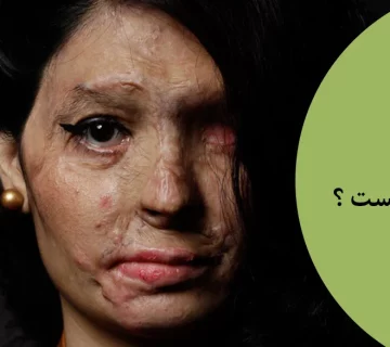 مجازات اسید پاشی